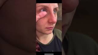 How To Use The Dmv Ultra And Dmv Scleral Cup With Scleral Lens Removal