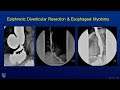 Minimally Invasive Epiphrenic Diverticular Resection & Esophageal Myotomy