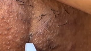 INGROWN HAIR REMOVAL #109