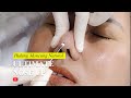 Tanam Benang Hidung, buat MANCUNG NATURAL! || NOVI'S Dermatology