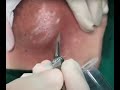 Abscess Drainage - Drenagem de um Abscesso