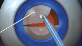 Cataract removal Procedure - Cataract Operation