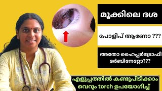 How to differentiate nasal poly and turbinate easily with torch/മൂക്കിലെ ദശ എങ്ങിനെ തിരിച്ചറിയാം?