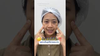 ยิ้มแล้วไม่มั่นใจ!! เพราะเห็นถุงใต้ตาเยอะมาก #inzclinic #inZeye #ศัลยกรรมตา #จักษุแพทย์ #ถุงใต้ตา