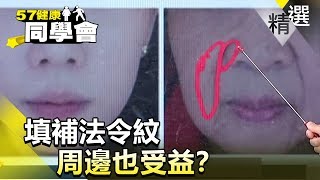 填補法令紋 周邊也受益？【健康同學會】精華篇