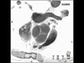 cardiac marfan s syndrome 4 of 7