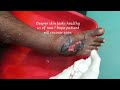 degloving injury foot post operative surgical dressings wound care adamya hospital videos