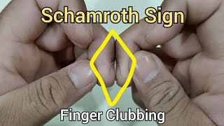 Schamroth Sign for the Examination of Finger Clubbing