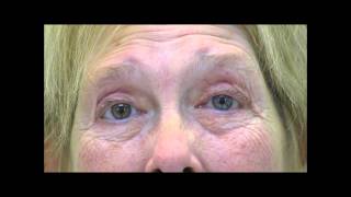 VIMPAT Blepharospasm Hemifacial Spasm Testimonial #2