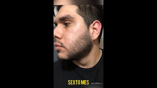 Resultados usando minoxidil Kirkland en 6 meses