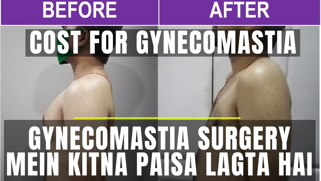 Cost Of Gynecomastia In India Straight To The Point Facts Explained By ...