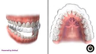 Clear Removable Appliance