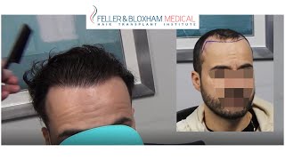 3,267 Graft Hairline and Temple Hair Transplant Results | Feller \u0026 Bloxham Medical, NYC, Long Island