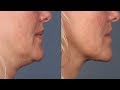 how to get rid of neck fat and lines