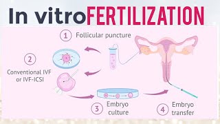 In vitro Fertilization (IVF) ||Notes 📝