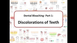 Dental Bleaching- Part 1: Causes of Teeth Discolorations