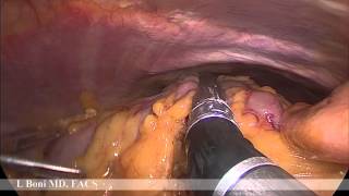 Technique for Laparoscopic Right Colectomy With Intracorporeal Anastomosis