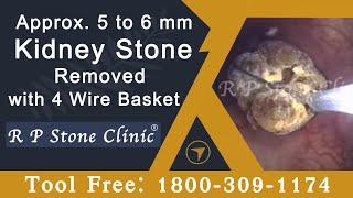 Approx. 5 to 6 mm Kidney Stone Removed with 4 Wire Basket