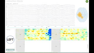 How to remove ECG beats from EEG recordings