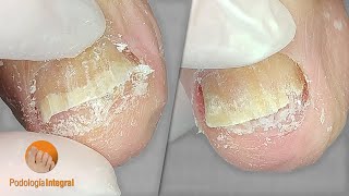 Toenails with fungus | Podological procedure