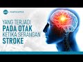 Serangan Stroke? Ini Yang Terjadi Pada Otak | Hidup Sehat tvOne