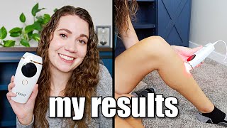 MY RESULTS | Nood The Flasher 2.0 | at home IPL hair removal