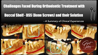 [LECTURE :12] Challenges in Treatment with Buccal Shelf Screws (BSS) | Orthodontic Bone Screws (OBS)