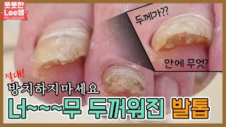 너무 너무 두꺼워진 문제성발톱! 절대 방치하지마세요 athlete's foot / tinea pedis / onychomycosis - Fresh Foot 성수점 / 남양주호평점