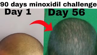 Day 56 of Using Minoxidil | Hair Fall Control \u0026 Growth Update