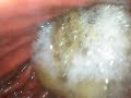 soda on an empty stomach endoscope vore