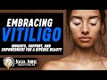 Breaking the Stigma: Revolutionary Vitiligo Correction Treatment Unveiled! | The Kayakriti Clinic