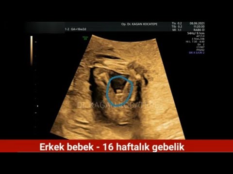 16 Haftalık Erkek Bebek Rahim Içi Ultrason Görüntüleri - Dr. Kağan ...