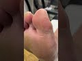 watch a podiatrist remove hard skin and calluses from big toe dry cracked skin treatment