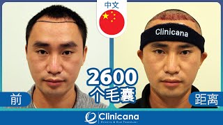 罗先生在Clinicana的植发简单体会和感受