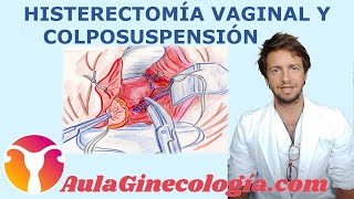 HISTERECTOMÍA VAGINAL y COLPOSUSPENSIÓN: PASO a PASO   - Ginecología y Obstetricia -