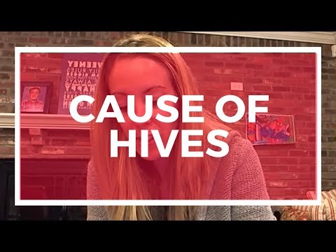 FINALLY Found Out The Cause Of My Hives! You Won't Believe It FINALLY Found Out The Cause Of My Hives! You Won't Believe It