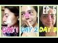 Rhinoplasty at 16 Vlog: DAY 1, 2, & 3 AFTER SURGERY! Episode 5