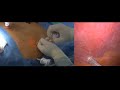 laparoscopic cholecystectomy surgery schwartz