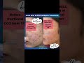 Acne scar treatment|acne scars|Fractional CO2 laser treatment |Dr Ashima Goel #shorts #youtubeshorts