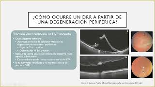 Degeneraciones Retinianas Periféricas - Seminario Residentes U El Bosque