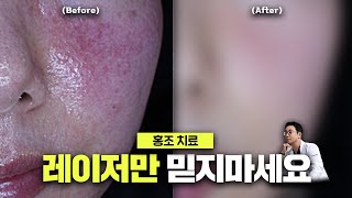 얼굴이 화끈거리고 붉어지는 안면 홍조의 원인과 올바른 치료법 / 얼굴 홍조 치료하는 법