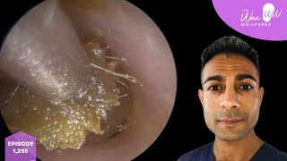 1,255 - Deep Itchy Dead Skin \u0026 Ear Wax Removal