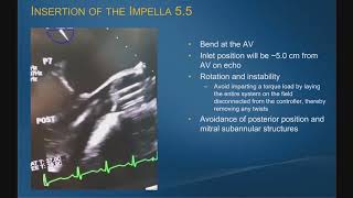 Impella 5.5 with SmartAssist: Implantation Experience