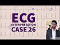 ECG MADE EASY CASE 26| ECG| EKG| ELECTROCARDIOGRAM| EDUCATIONAL VIDEO