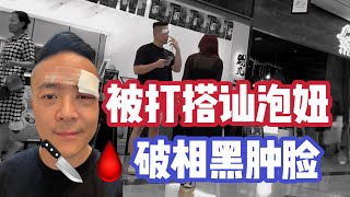 破相還能搭訕撩妹？女人以為被打 | 臉部受傷把妹 | 被打還上街？搭訕大師