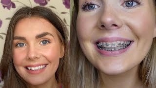 One year of braces.. update \u0026 experience | Orlaith Duffy | #braces #orthodontics