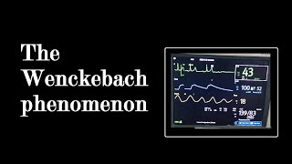 Second degree Heart Block - Mobitz type 1 | Wanckebach Phenomenon