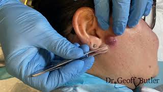 Drainage of an infected cyst in front of the ear