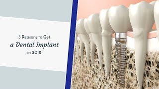 5 Reasons to Get a Dental Implant in 2018