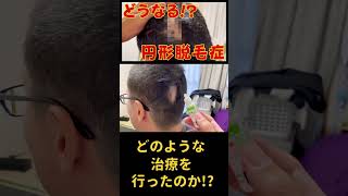 【完全密着ドキュメント!!】円形脱毛症～治療経過報告～#shorts